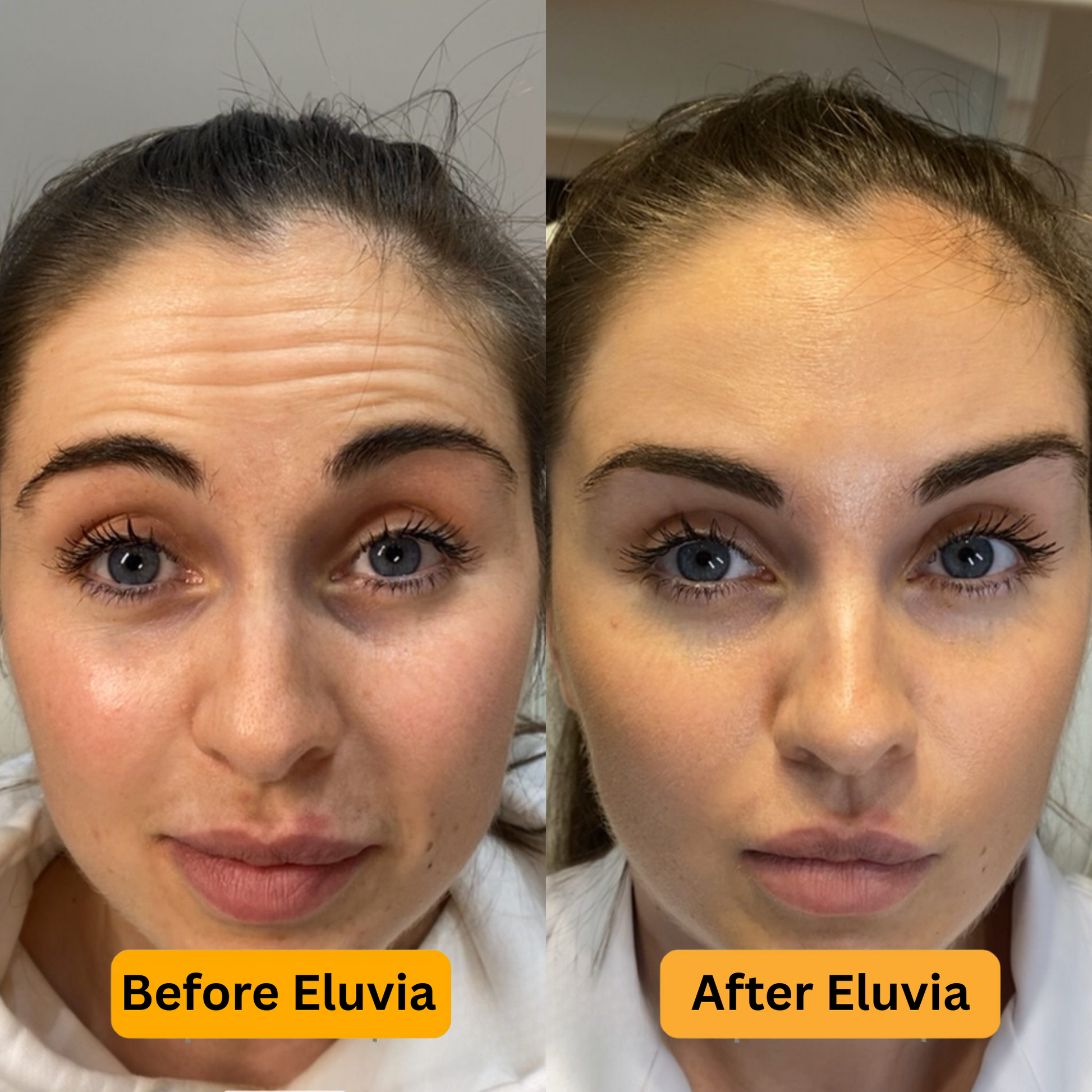 Before and after comparison of a woman's face with Eluvia treatment.